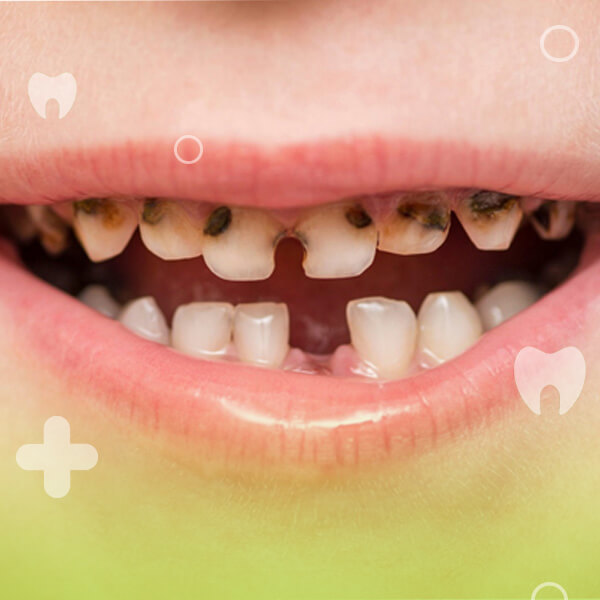 علت  پوسیدگی دندان در کودکان