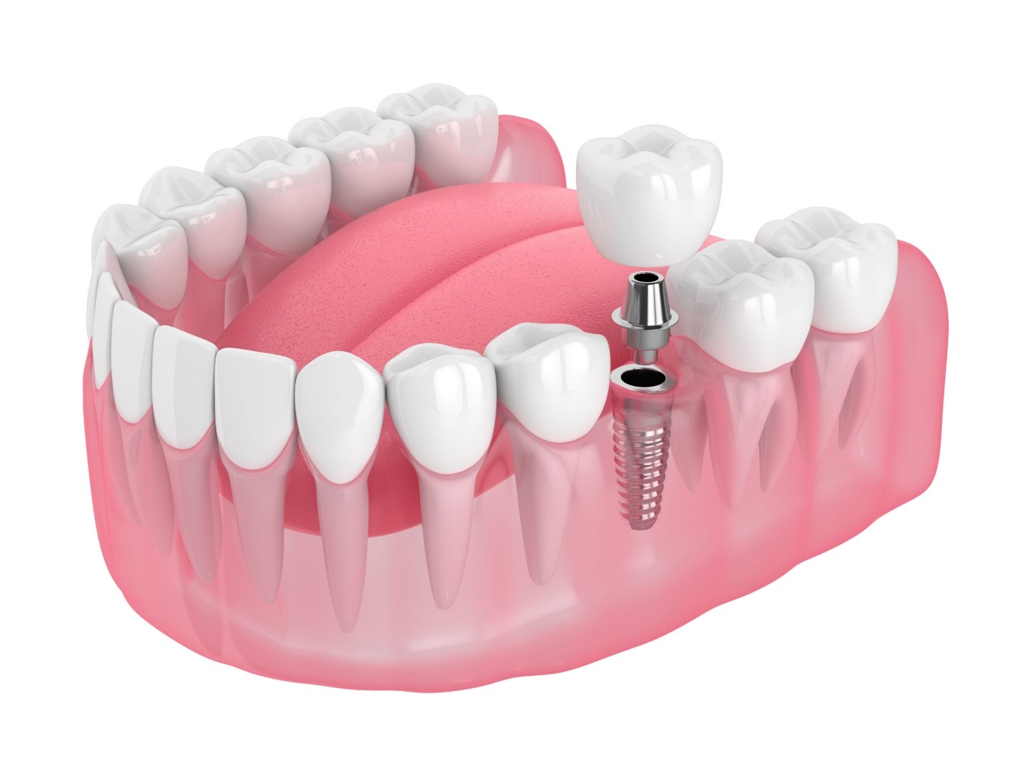 dental-implant-loosening