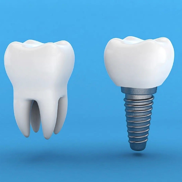 چه مدت پس از کشیدن دندان باید ایمپلنت کرد؟
