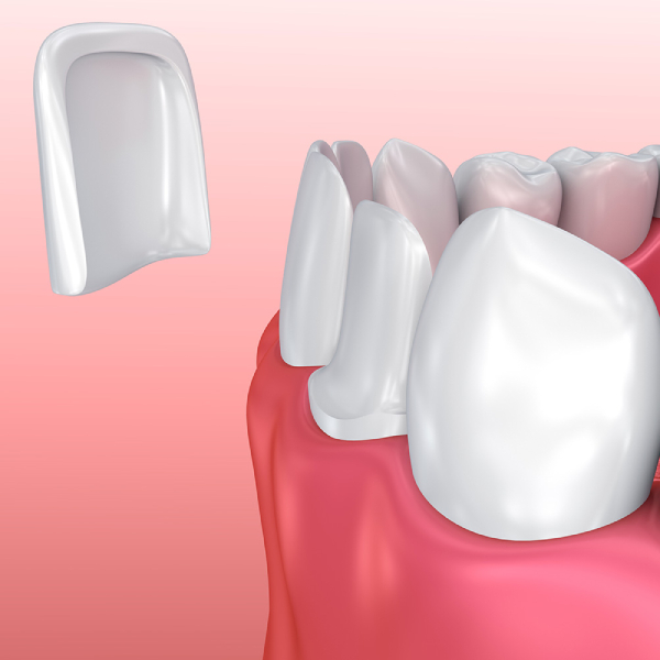 how-is-dental-composite