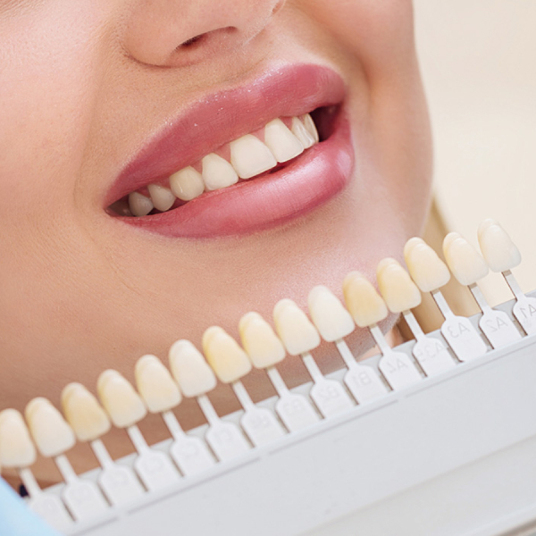 factors-affecting-the-lifespan-of-dental-laminate