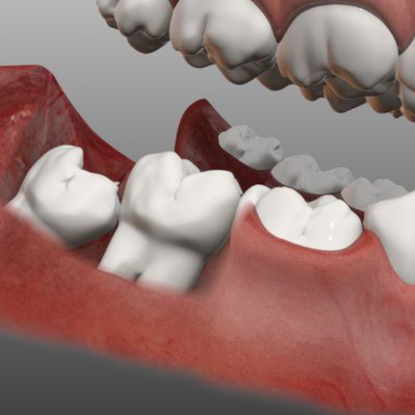 complications-of-not-pulling-wisdom-teeth-on-time