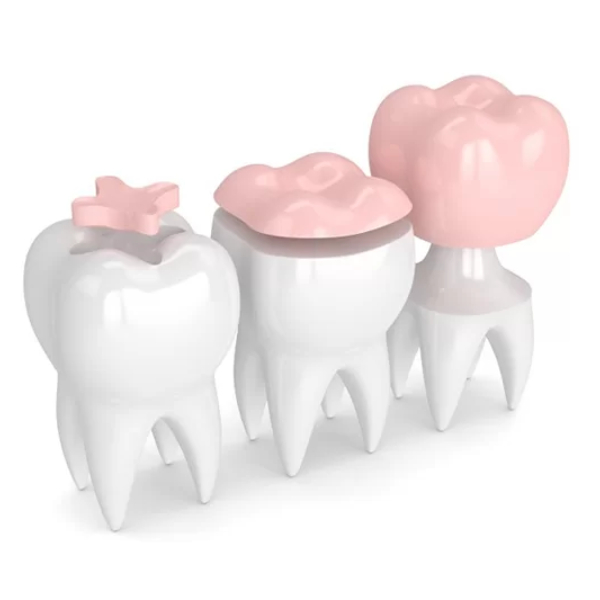 dental-inlays-and-onlays