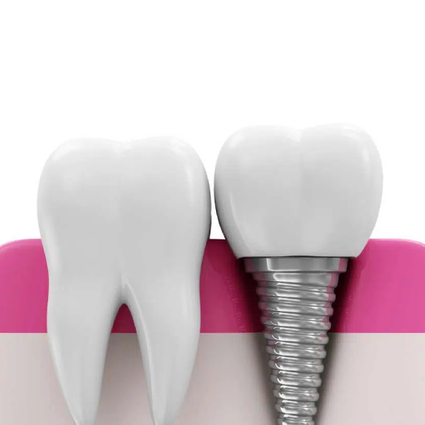 age-limit-for-dental-implant-placement