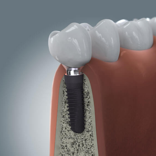 jaw-bone-grafting-for-dental-implants