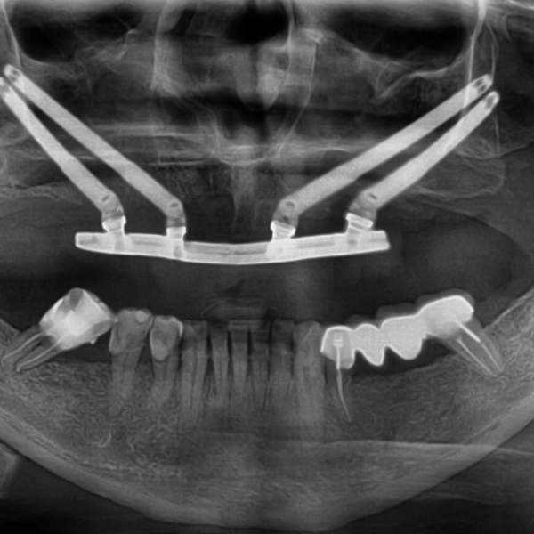 zygomatic-implant