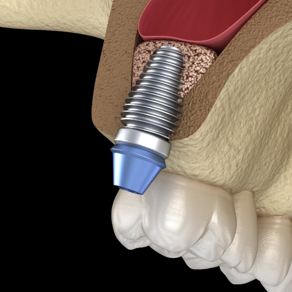 bone-grafting-for-implants