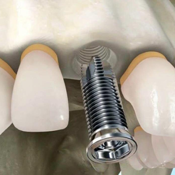 dental-implant-screw-breakage