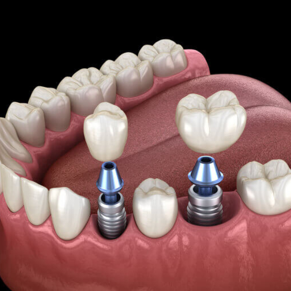 orthodontics-after-implants