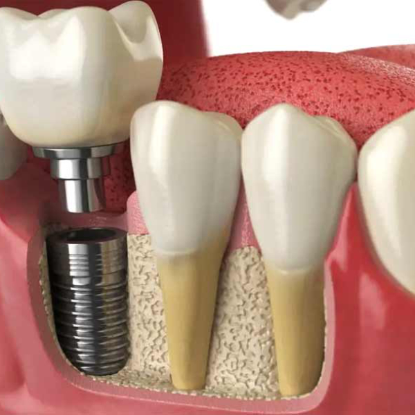 comparing-dental-implants-with-other-tooth-replacement-methods