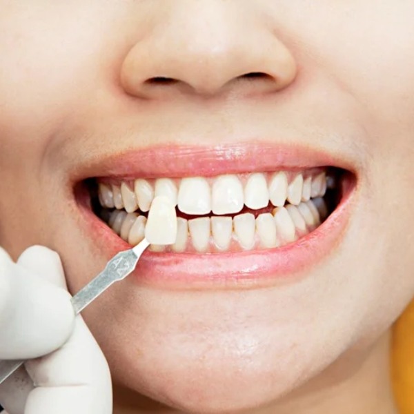 dental-laminate-and-increase-self-confidence