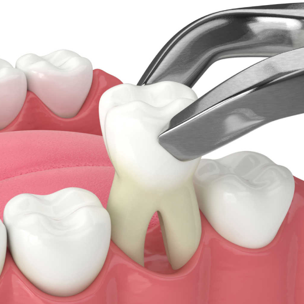 solutions-to-prevent-the-need-for-tooth-extraction