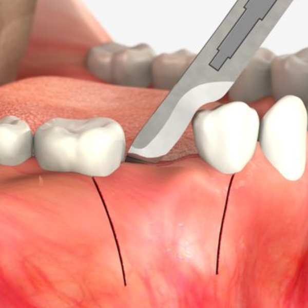 the-role-of-gum-surgery-in-the-treatment-of-advanced-periodontal-diseases