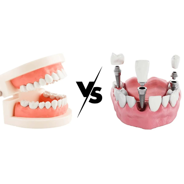 comparison-of-laminate-and-implant