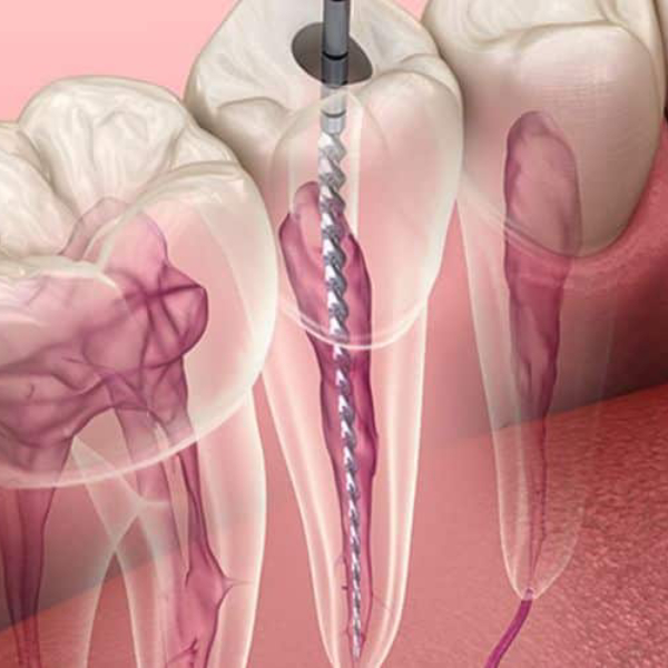 when-should-we-use-root-canal-treatment