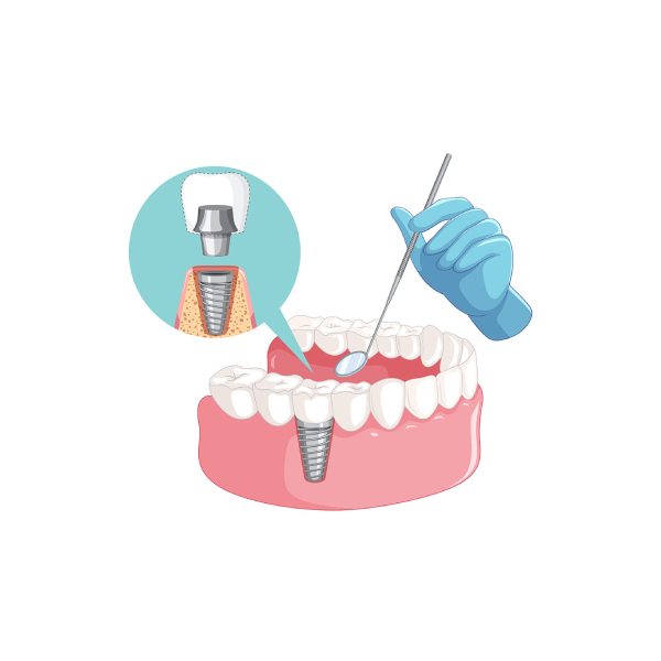 care-after-dental-implant-installation