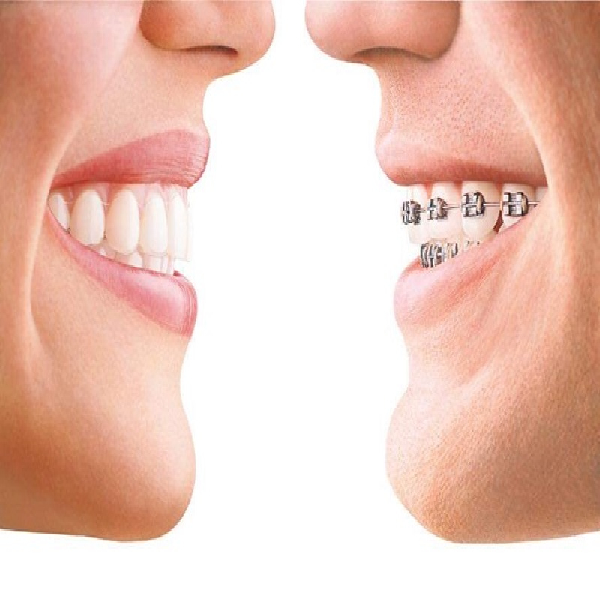 comparison-and-review-of-orthodontic-treatments