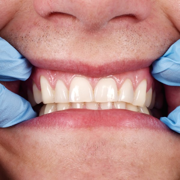 what-your-teeth-reveal-about-your-overall-health