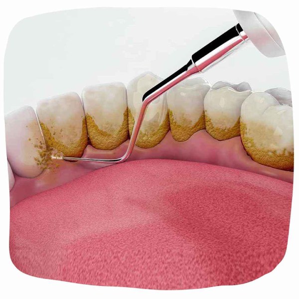 reasons-for-teeth-sensitivity-after-scaling
