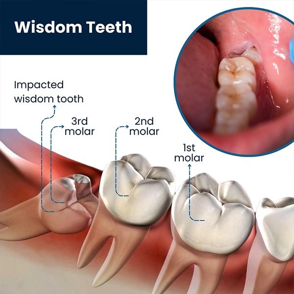 wisdom-tooth-extraction