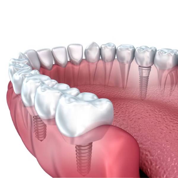 dental-implant-cost-in-1404