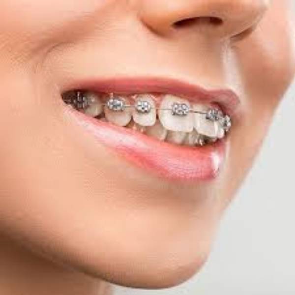 orthodontics-in-adults