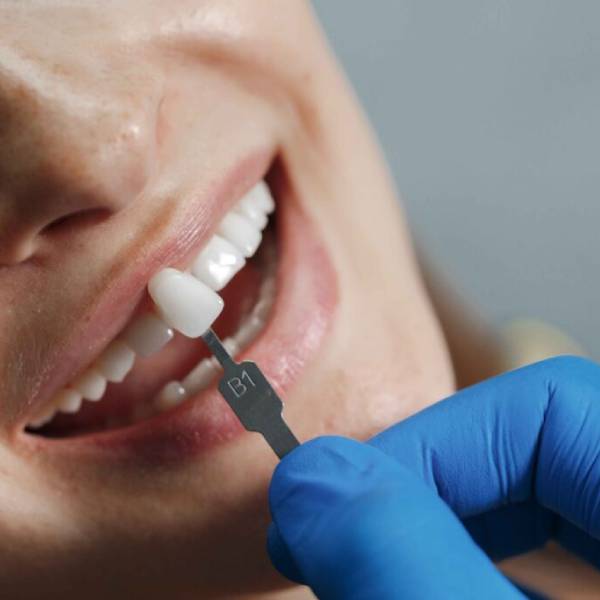 dental-laminate-or-composite