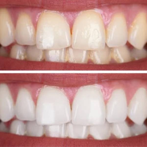 teeth-scalin-steps-benefits-and-post-scaling-care
