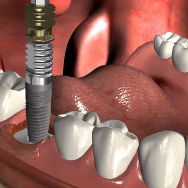 what-is-an-immediate-implant