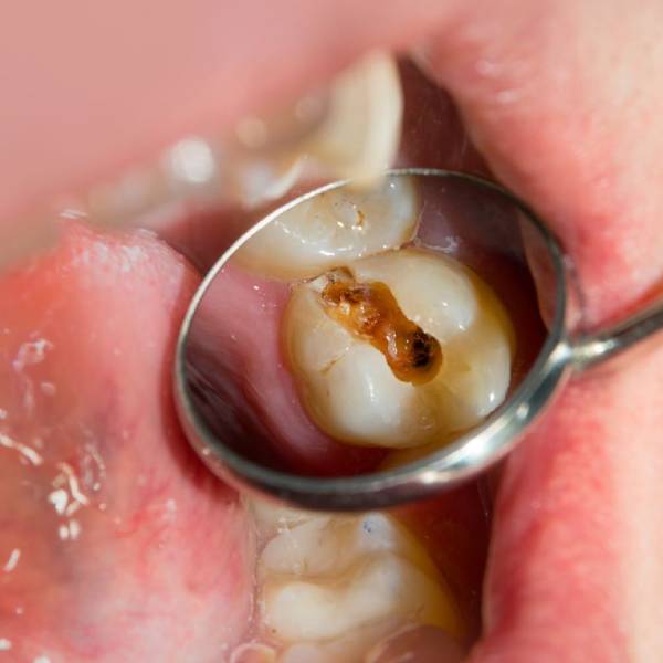 methods-for-preventing-tooth-decay