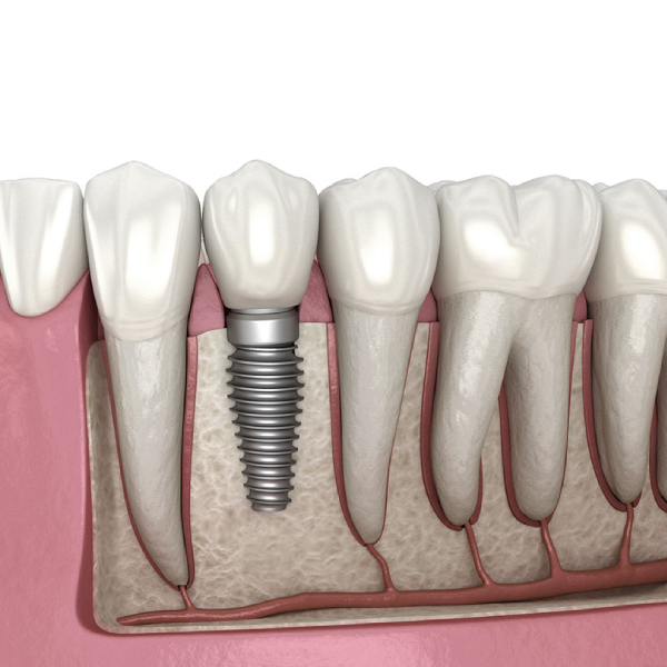 dental-implant-placement-steps