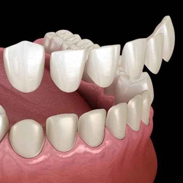 common-mistakes-patients-make-after-dental-lamination