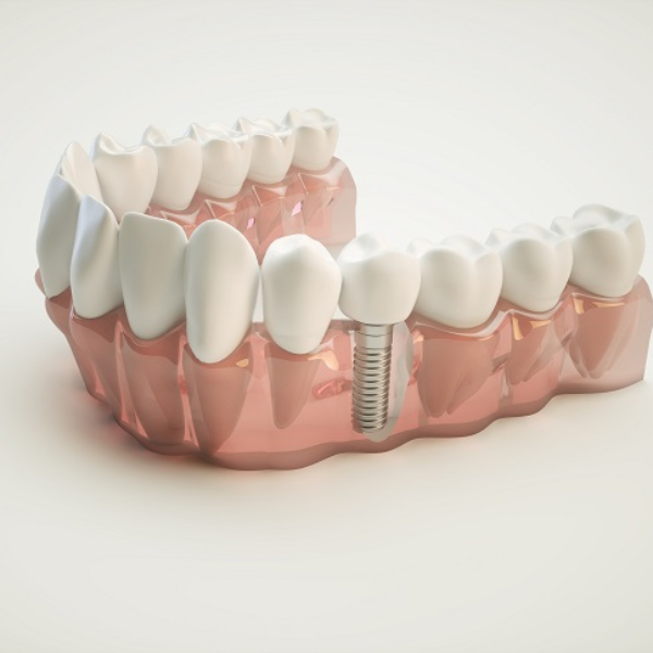 care-after-dental-implant-installation