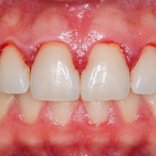 gum-disease-treatment