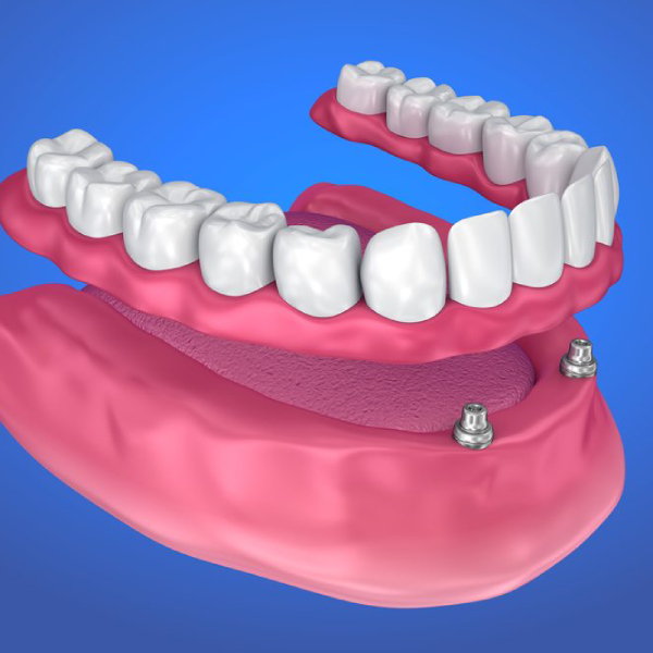 What is an overdenture?
