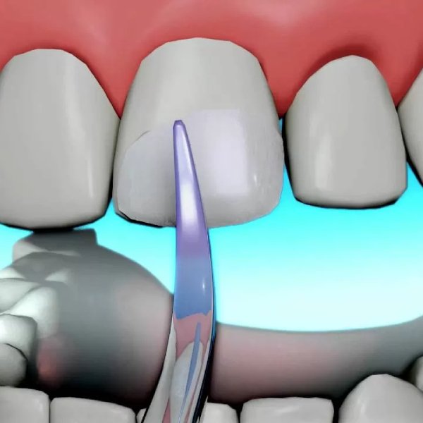 عوارض عصب کشی دندان عفونی