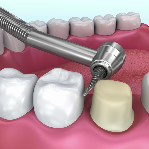 تفاوت بین روکش دندان و بیلداپ دندان در بازسازی تاج دندان