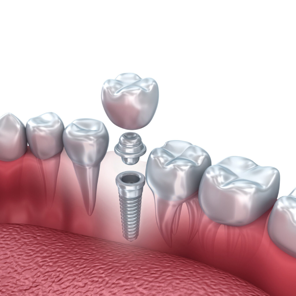 bone-grafting-for-implants