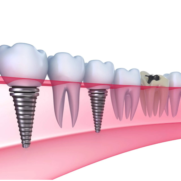 comparison of dental implant and dental bridge