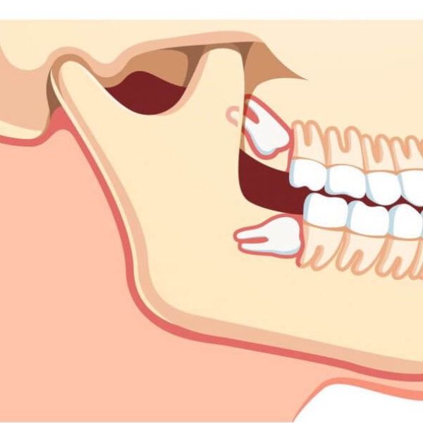 complications-of-not-pulling-wisdom-teeth-on-time2