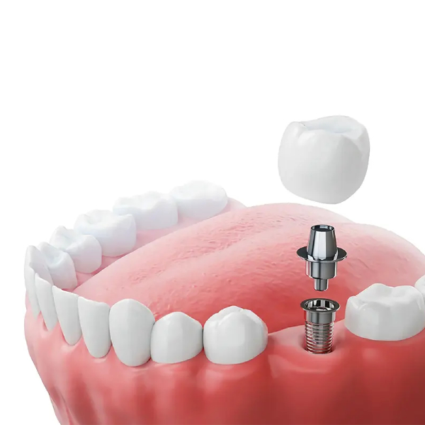 dental-implant-screw-breakage2