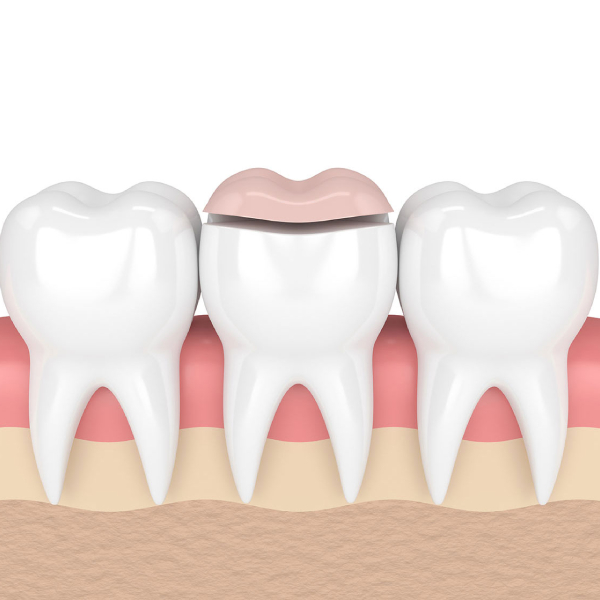 dental-inlays-and-onlays2