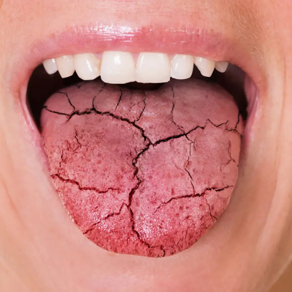 dry-mouth-causes-and-treatment-methods