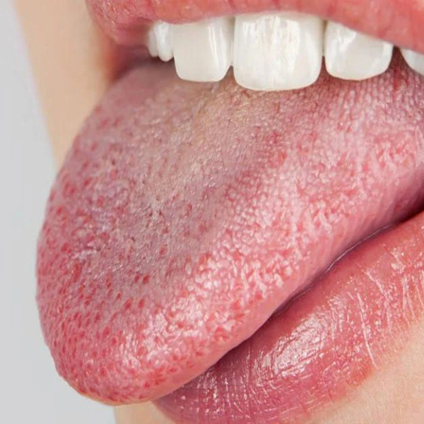 dry-mouth-causes-and-treatment-methods3