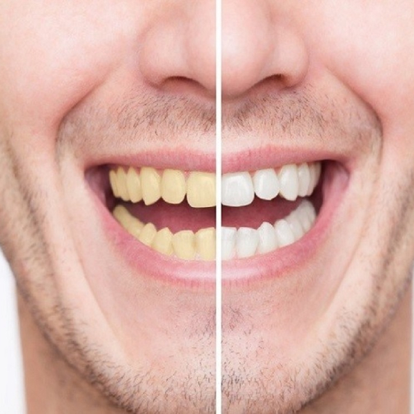 exfoliation and teeth whitening