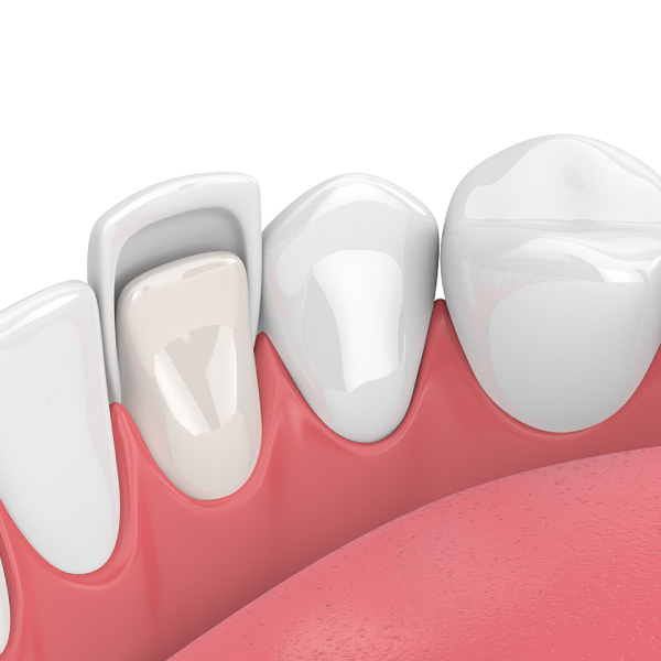 how-is-dental-composite2