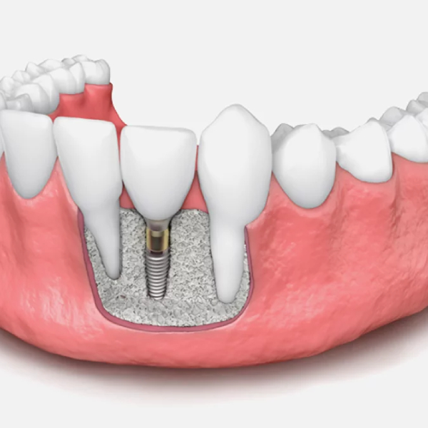 jaw-bone-grafting-for-dental-implants