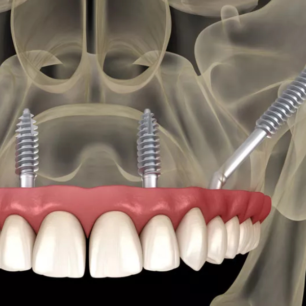 jaw-bone-grafting-for-dental-implants2