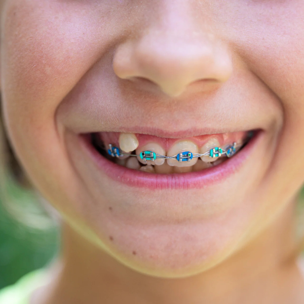 orthodontics-to-correct-missing-teeth3