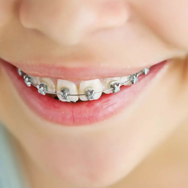 the-best-age-for-orthodontics